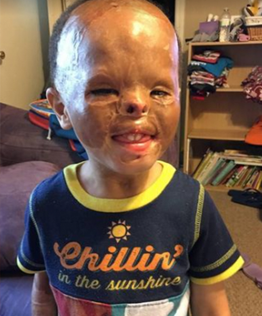 Foster baby is adopted 7 years after apartment fire left him with horrific burns